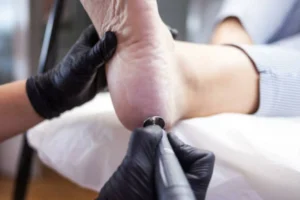 Callus Removal