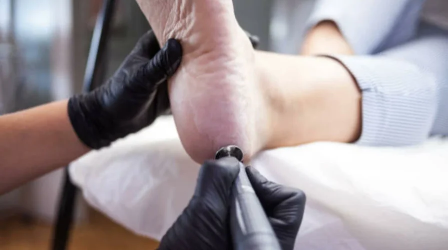 Callus Removal